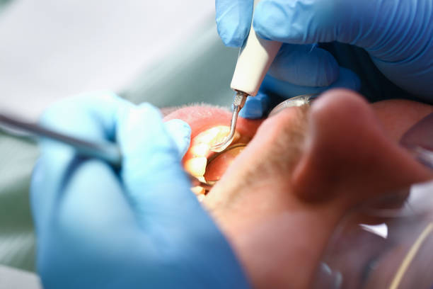 Best Emergency Root Canal Treatment in Parkville, MO