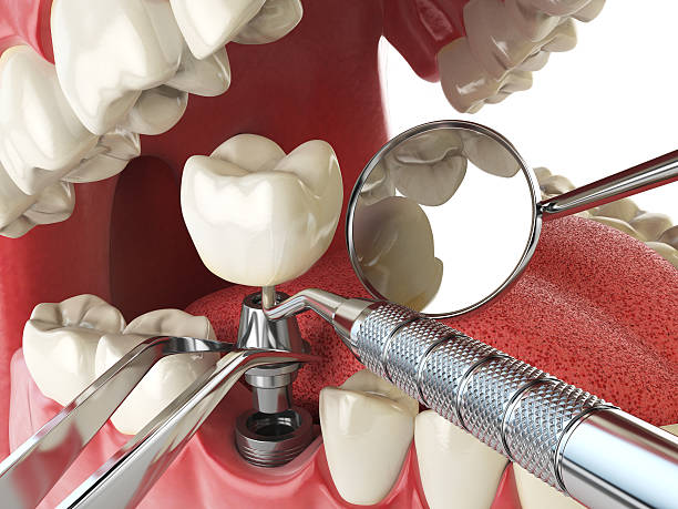 Best Emergency Wisdom Teeth Removal in Parkville, MO